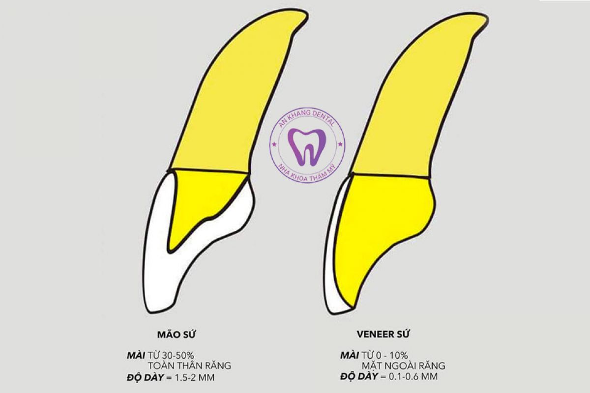 SO SÁNH MÃO SỨ VÀ MẶT DÁN SỨ