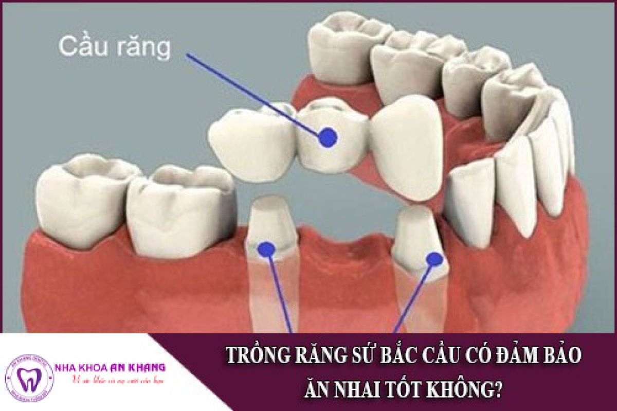 VÌ SAO MẤT RĂNG NÊN TRỒNG LẠI RĂNG CÀNG SỚM CÀNG TỐT?