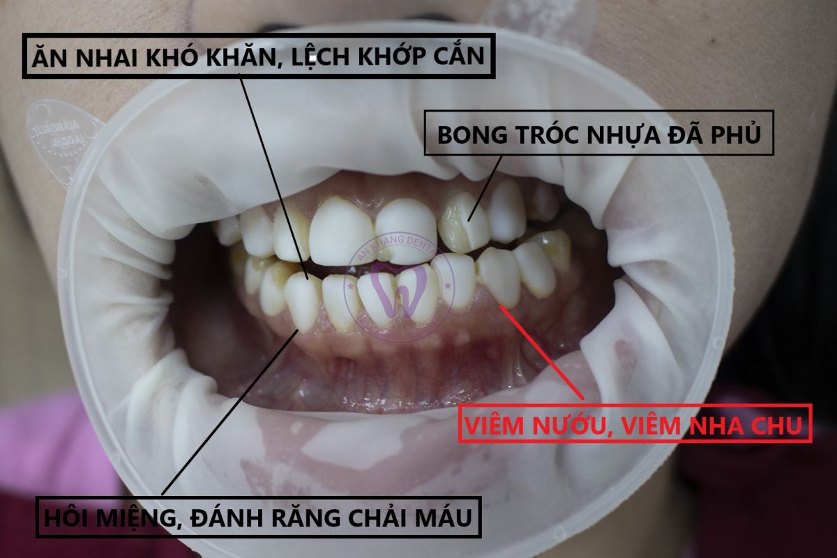 LẦM TƯỞNG PHỦ SỨ NANO LÀ DÁN SỨ VENEER - VẬY KHÁC NHAU Ở ĐIỂM NÀO?