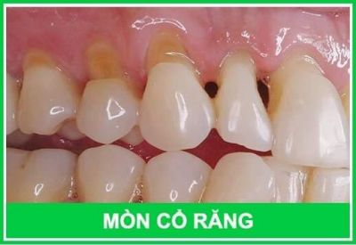 MÒN CỔ RĂNG - Nguyên nhân và Cách khắc phục